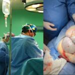 Кендзежин-Козле: врачи вырезали пациентке опухоль яичника весом 11 кг.  Он мог расти несколько лет